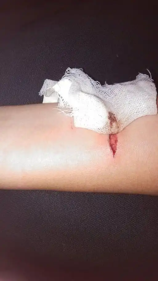 被玻璃划的伤口有点大,还是深的,需不需要缝针!