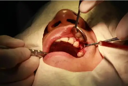 手术切口 翻瓣后见左上 近中牙槽骨吸收至根尖,根面上少量牙石附着,质