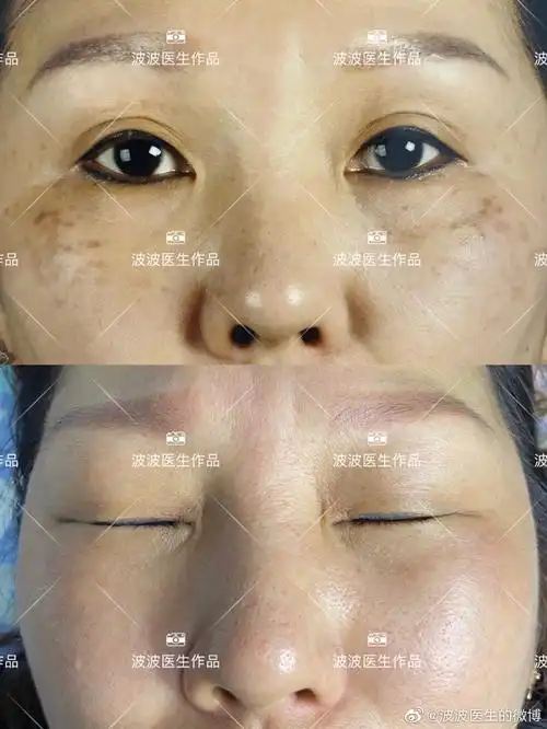 颧部褐青色痣 - 好大夫在线