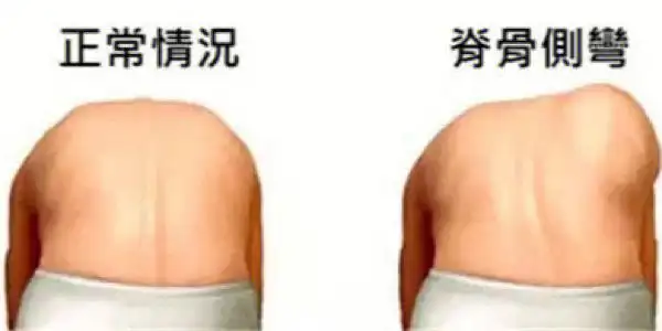 科专家98697115联合开展"关注青少年脊柱侧弯"康复专家面对面