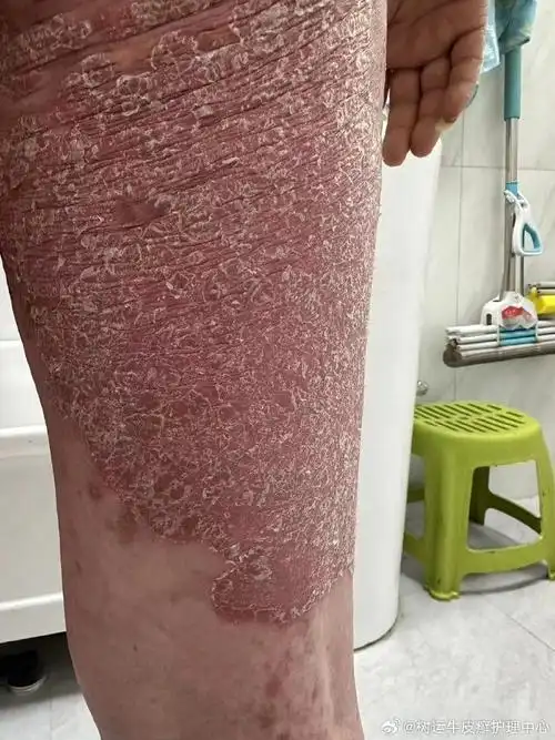 没有最严重只有更严重#银屑病##牛皮癣