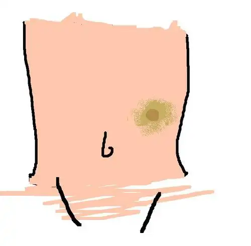 腹部包块,这是什么来的?