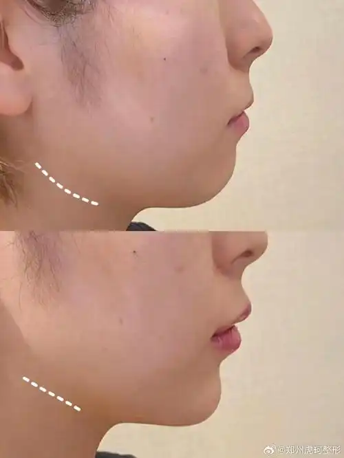下颌线##下巴##下巴填充##医美科普##医美攻略##侧颜美学##侧颜杀
