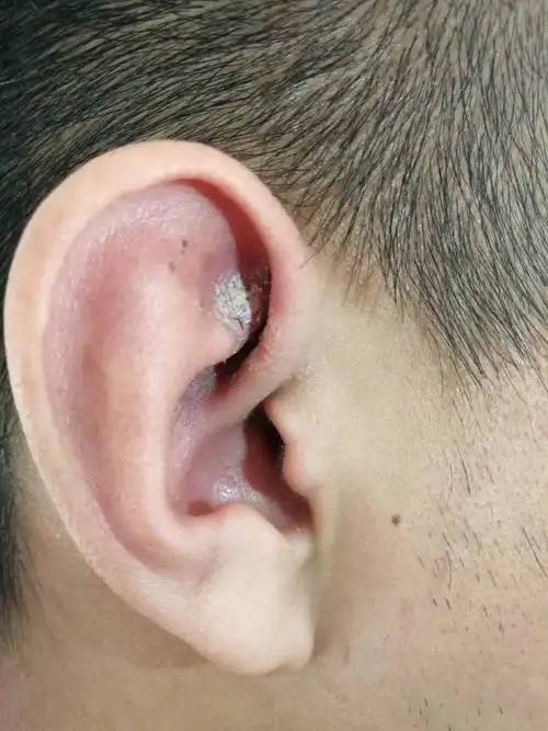 耳朵耳道处,有经常流脓然后就变成这样的,是什么问题呢?