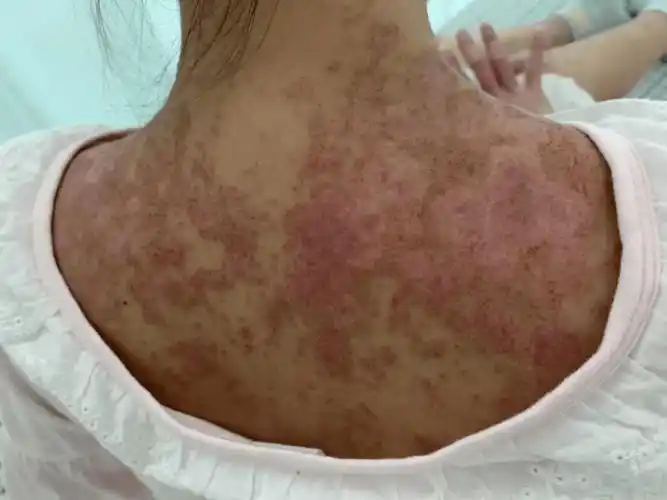 育龄女性要注意厚街一宝妈患病只能控制不能治愈