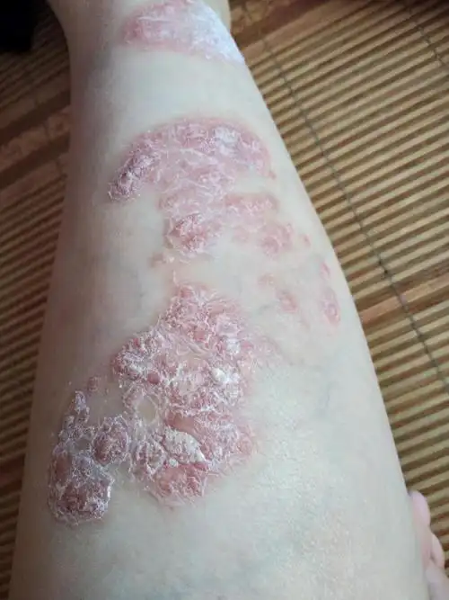 十年牛皮癣,四个多月基本恢复,想知道为什么?请看