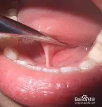 连舌其实就是舌系带过短,但怎么确定宝宝是