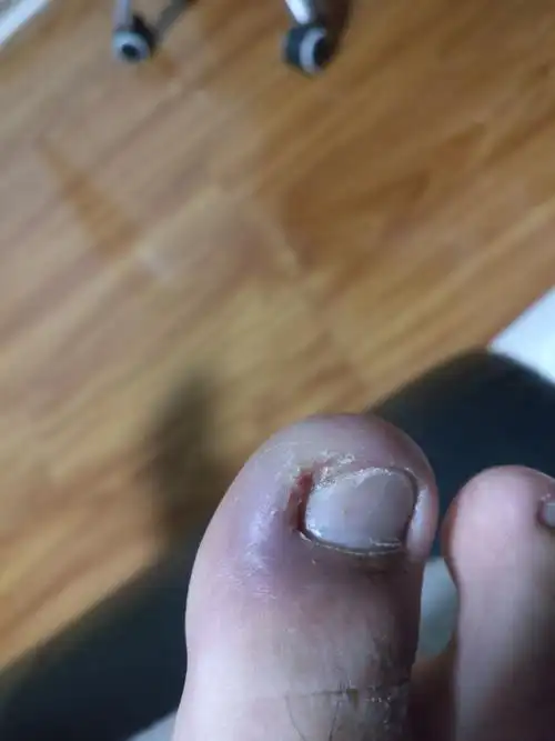 发布于2016-10-13 21:35   最佳答案 这是甲沟炎的症状.