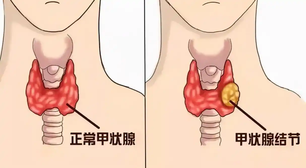 慢性淋巴细胞性甲状腺炎,发病之后严重影响生活,要积极治疗