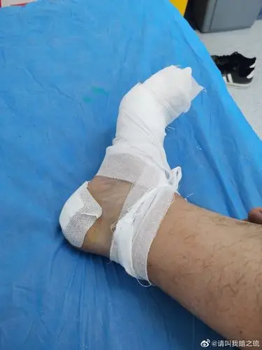 2月8日早上,在医院做完包扎后我的脚