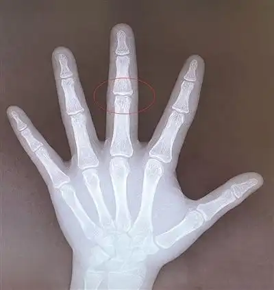 单凭骨龄并不能准确预测身高