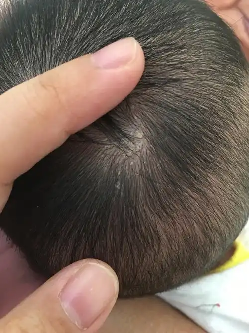 宝宝头上长了像头皮屑似的东西