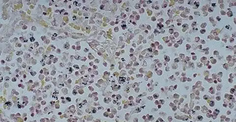 肺泡腔内渗出的中性粒细胞吞噬了g 细菌