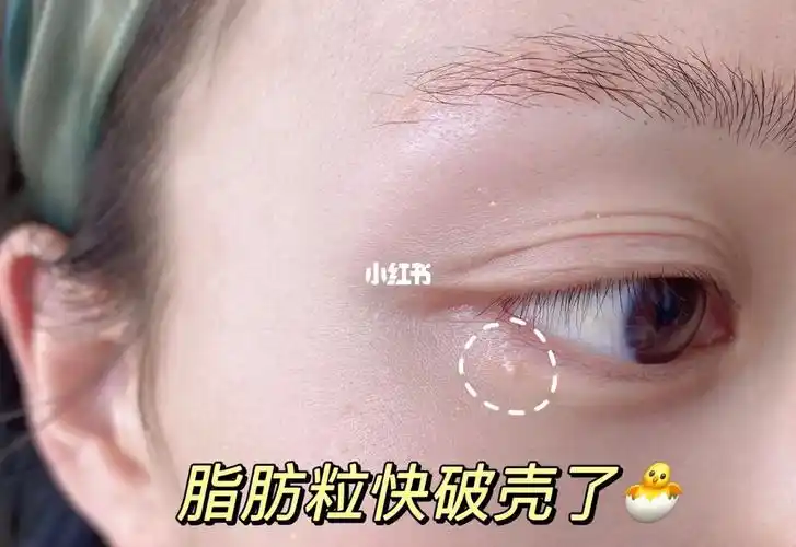 顽固的脂肪粒终于被我亲手消灭了