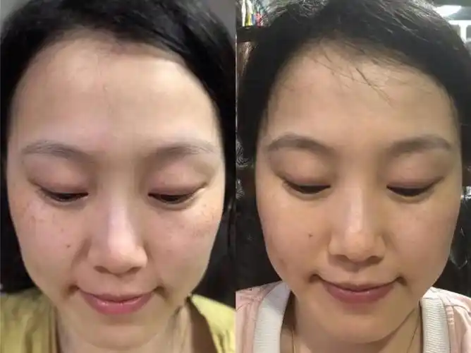 医美祛斑真的有用吗激光皮秒超皮秒哪个最有效大概多少钱