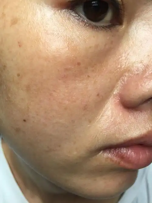 突然间这样发现这么多色素沉淀,暗黄不好接受,不敢出门见人,怎么办?