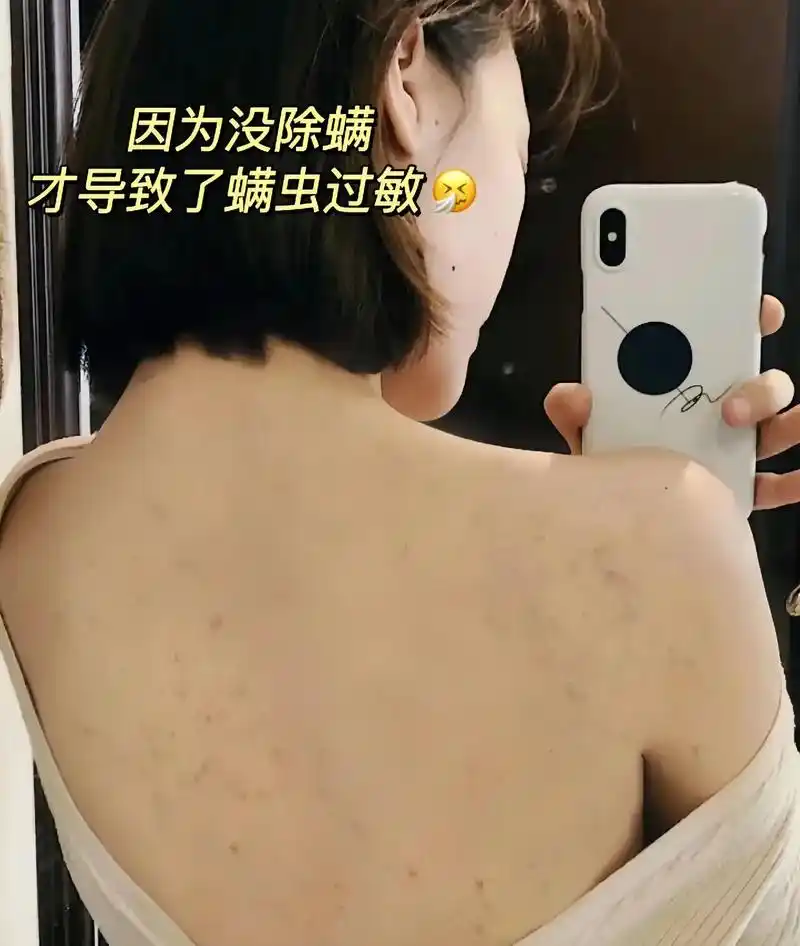 螨虫咬你满背的包,太可怕了.螨虫长了八只脚,看不见摸不着,繁 - 抖音