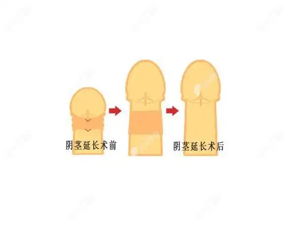 阴茎延长术价格一览看男性做阴茎增长手术一般要多少钱
