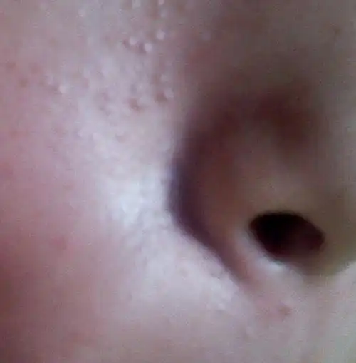 鼻子周围长了好多小疙瘩,应该不属于痘痘,和皮肤一个颜色,看到没就是