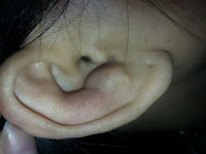 耳朵上长了个包有点硬有两个月了按下去有点痛硬包周围有