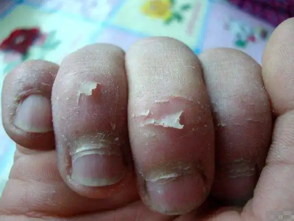 补救办法:少儿指甲有白斑要注意打虫,秋季时候注意吃打虫药.