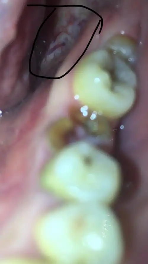 我图片里的白色像扁平苔藓吗,会恶变吗