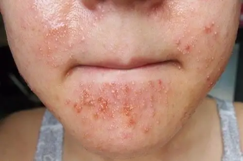 大部分染发产品在与皮肤接触时可能会产生刺激,这里发胶要尤为