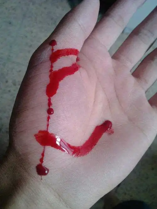 一个小伤口最后会慢慢地停止流血,但是严重的创伤可能就需要将伤口