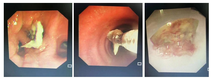 支气管异物取出术市三院呼吸与危重症医学科的又一种呼吸介入诊疗手段