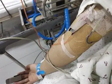 第一次化疗结束,瘦了6斤