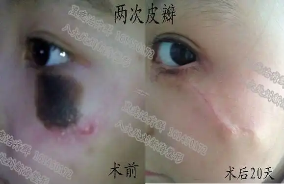 下眼睑黑痣皮瓣手术效果 - 好大夫在线