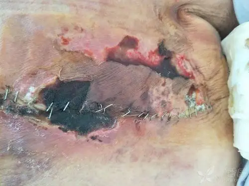 74 简要病史:患者因乳房肿块外院治疗,切除后病理乳腺浸润性导管癌,行