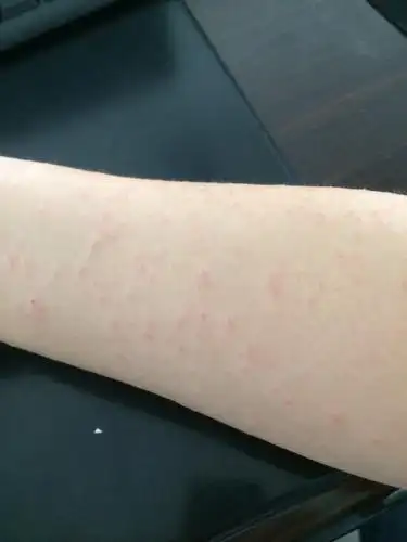 胳膊和腿上有好多,很痒,3到4天了,这是什么情况啊?皮肤过敏吗?