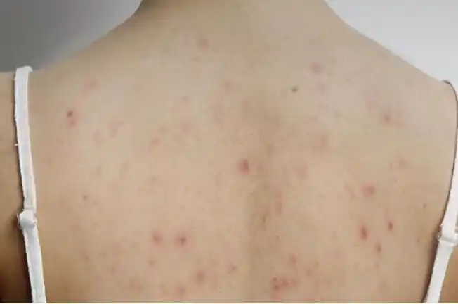 湿毒图片 (18)_有来医生