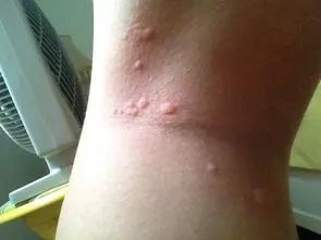 孩子长红疙瘩,医生建议回家翻看枕头!结果震惊了