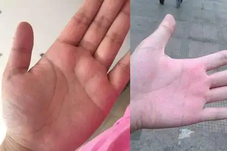 图正常手掌与肝掌比较健康小常识时刻谨记