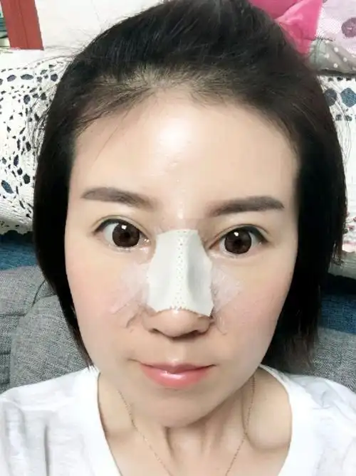 鼻子之前在美容院打过玻尿酸结果打完两个月之后鼻根变得越来越宽成了