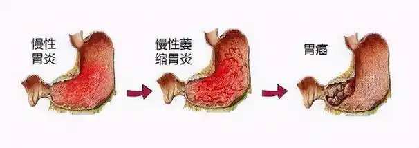 胃癌的早期症状,胃癌的早期症状女性前兆