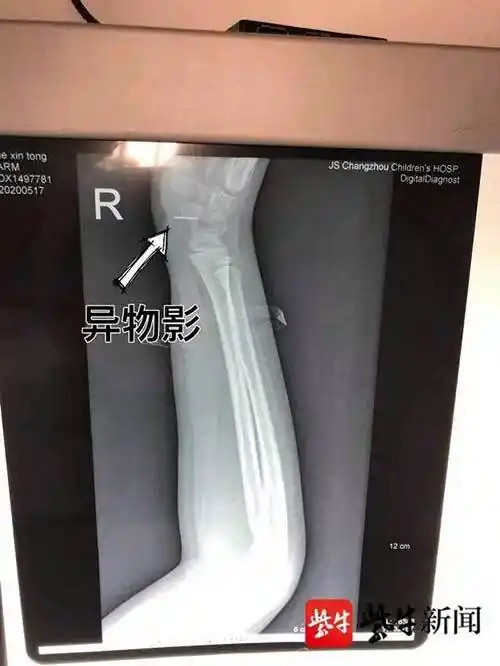 疼了4天才带娃就医8岁女孩手腕取出13cm钢针