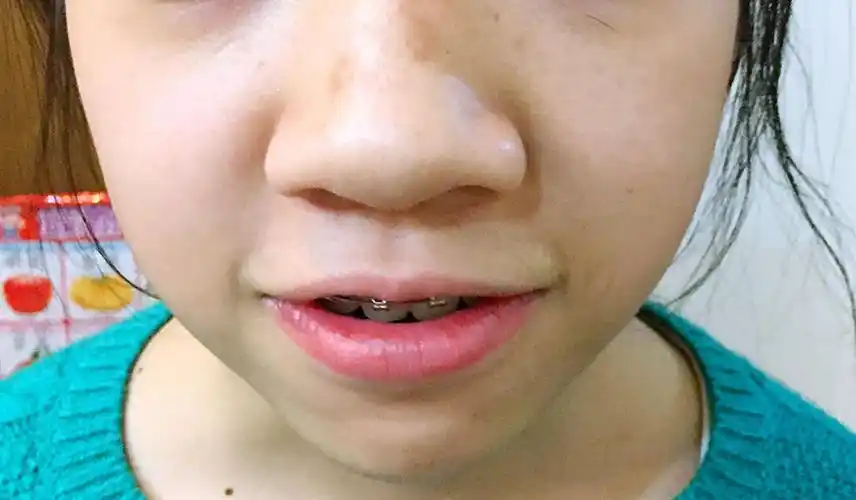 13岁孩子,以前得过鼻炎好了,现在觉得鼻子肉挺厚,有点大,需要去医院