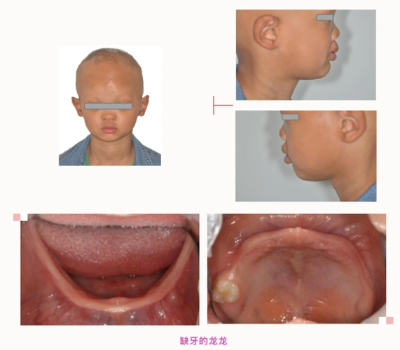 云南省口腔医院口腔修复科为3例外胚叶发育不全综合征患儿镶配全口