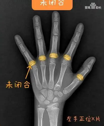 翌高骨龄检测机构健康检测相关