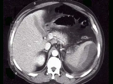 a,脾破裂实质内血肿 b,脾包膜下血肿 c,脾挫裂伤 d,脾梗死 e,脾扭转