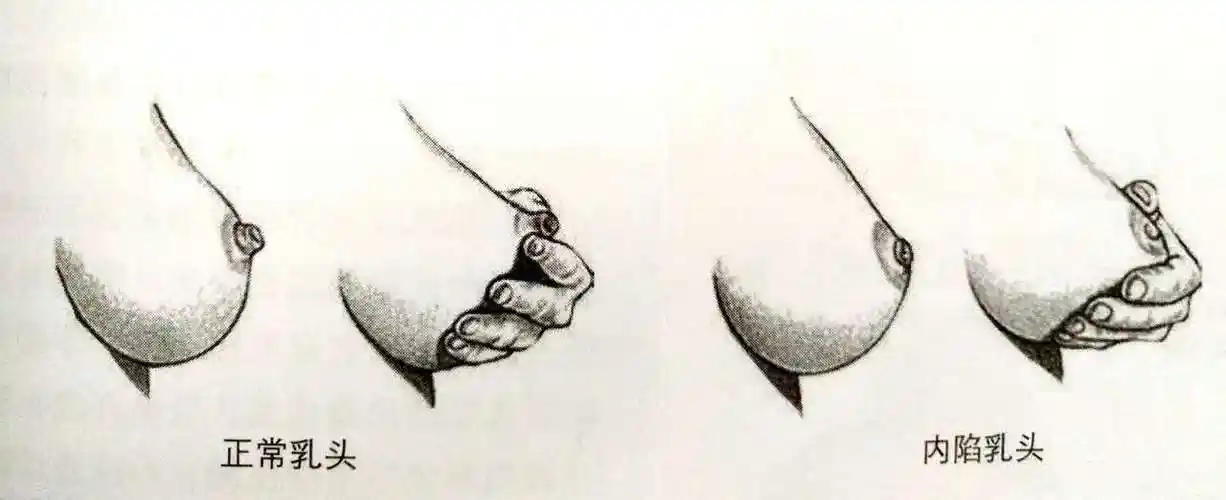 要知道,正常乳头在受到挤压或触碰刺激时,是会很快突出
