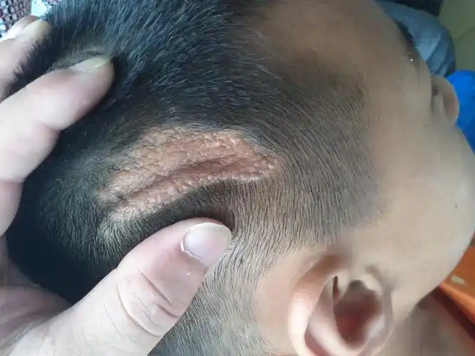 这孩子头皮上是什么问题