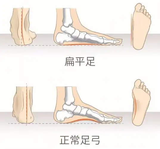 为什么扁平足一定要穿矫正足垫
