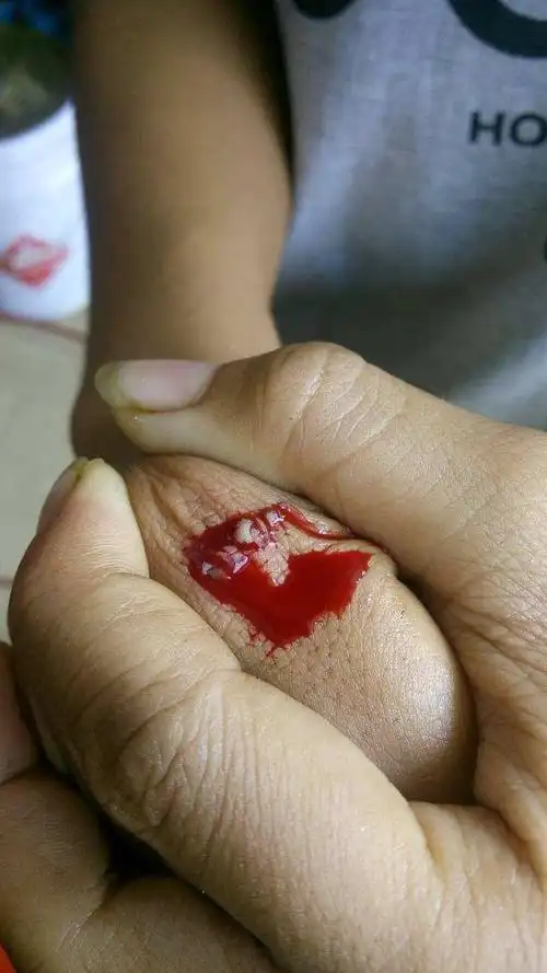 手指头流血止不住怎么办?手指出血一直止不住-图片大观-奇异网