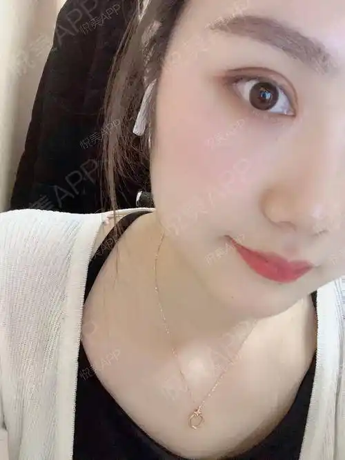 眼部多项术后240天_全切双眼皮术后240天_眼型矫正术后240天_眼部多项