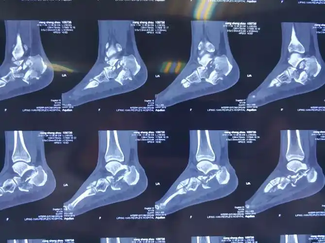 图示:跟骨粉碎性骨折,明显移位塌陷