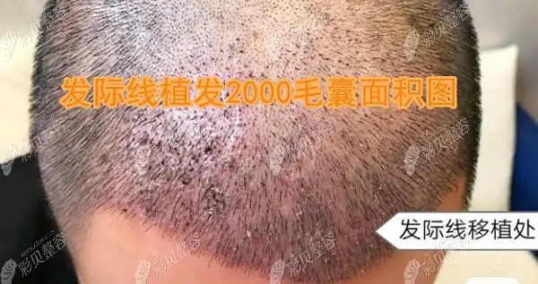 67看深圳大麦微针植发多少钱一个单位植发2000个毛囊面积图